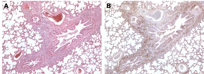 图3：猪肺炎支原体与PCV2混合感染的猪肺。A：猪肺炎支原体引起的支气管周围淋巴组织增生。B：PCV2抗原在同一区域的淋巴增生。